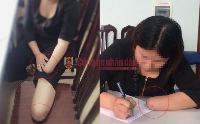 (HÃI HÙNG) Thuê người chặt chân, tay để trục lợi 3,5 tỷ tiền bảo hiểm