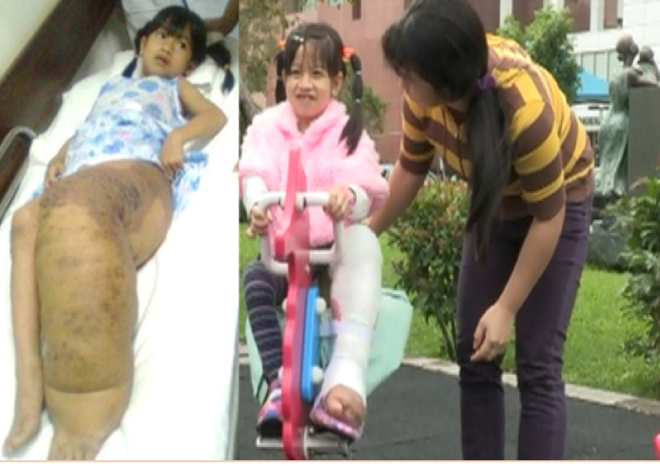 Hành trình đứng lên phi thường của cô bé “chân voi” ở Lâm Đồng