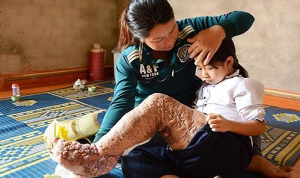 Lâm Đồng: Cô bé “chân voi” tiến gần giấc mơ chân sáo đến trường