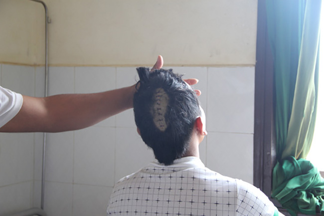 Di Linh: Lao vào quán bida, chém nứt sọ khách