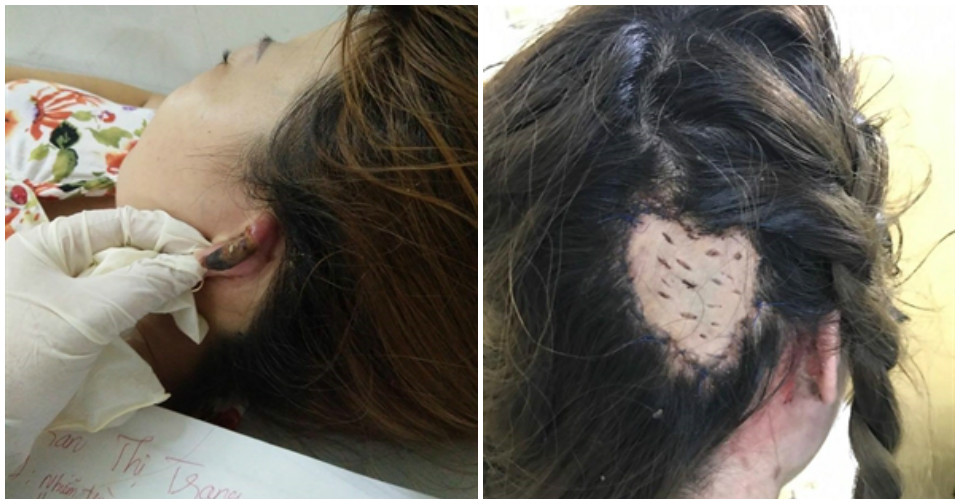 Lâm Đồng: Hoại tử vành tai, mất da đầu khi hấp tóc đón Tết