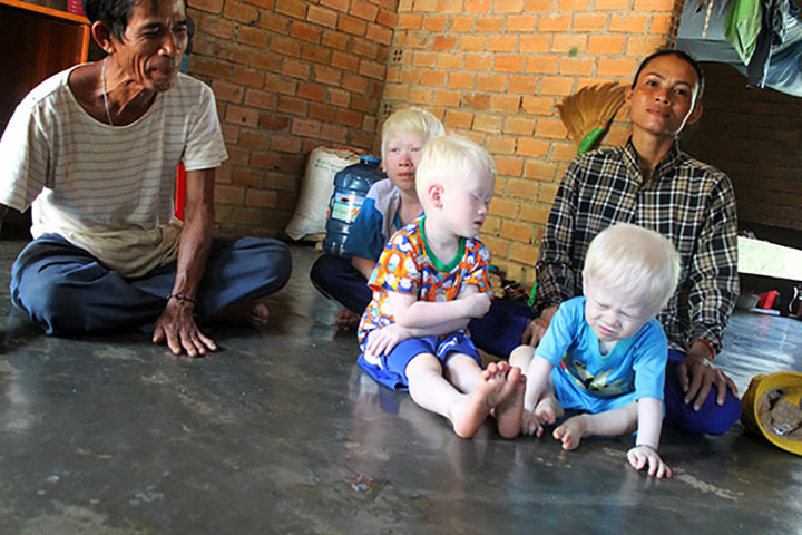 Lâm Đồng: Những đứa trẻ sợ ánh nắng