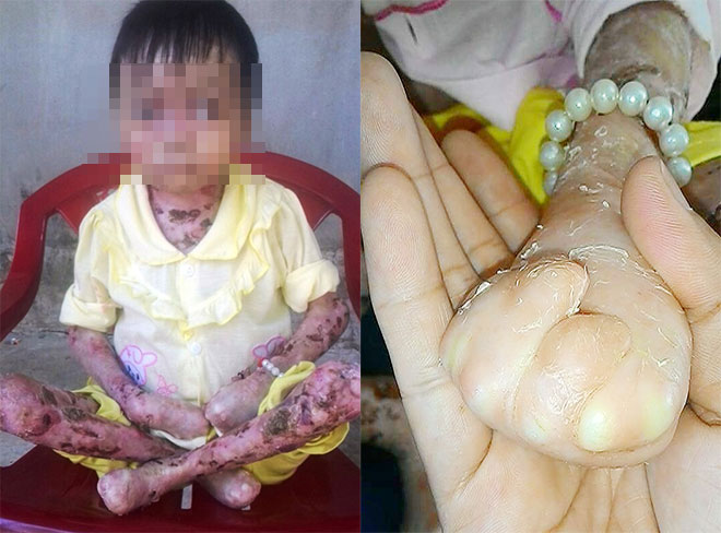 Lâm Đồng: Nhà nghèo, bé gái 8 tuổi đau đớn sống cảnh bong từng mảng thịt