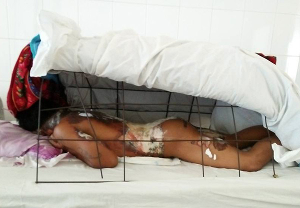 Lâm Đồng: Bị bỏng xăng nặng, cậu bé nghèo giành giật sự sống từng giờ