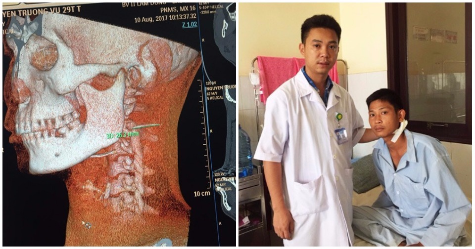 Bảo Lộc: Xương cá nằm suốt 3 tháng trong cổ họng