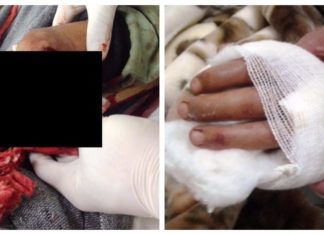 Đà Lạt: Nam thanh niên bị chém đứt lìa cổ tay