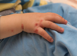 Lâm Đồng: Đã có 665 ca mắc bệnh tay chân miệng