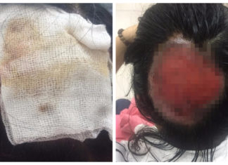Tóc cuốn vào ống dẫn nhiệt, nữ bác sĩ bỏng sâu, tróc gần như toàn bộ da đầu