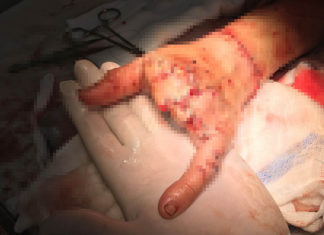 Đà Lạt: Nối thành công bàn tay bị máy cắt cỏ chém lìa