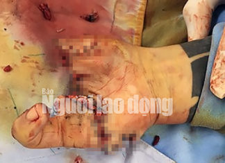 Đà Lạt: Tưởng lựu đạn giả cầm chơi, không ngờ nổ thật