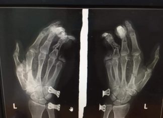 Bảo Lộc: Điện thoại phát nổ, nam thanh niên bị dập nát bàn tay