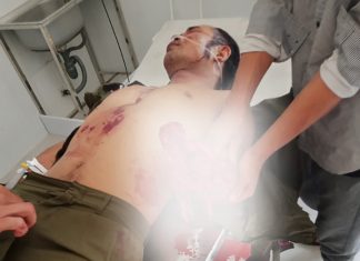 Lâm Đồng: Chế mìn đánh cá, 1 người bị mất bàn tay