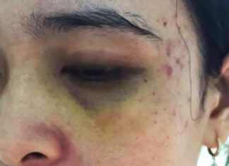 Bảo Lâm: Đánh người nhập viện vì không bán được đất vướng quy hoạch