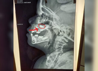 Lâm Đồng: Gây mê để lấy viên pin điện tử trong mũi bệnh nhi 32 tháng tuổi